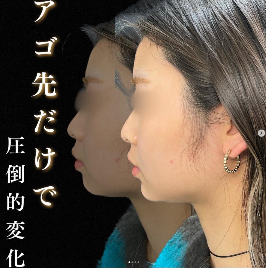 玻尿酸填充
