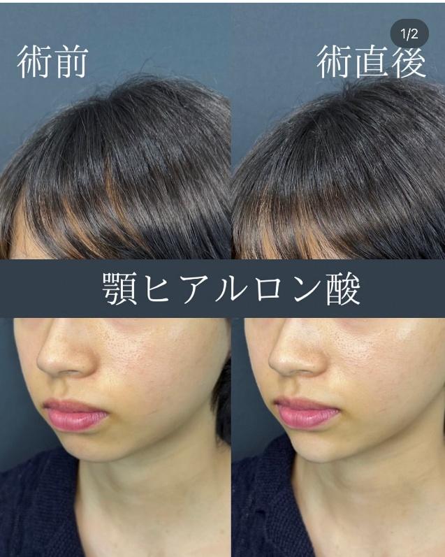 玻尿酸填充