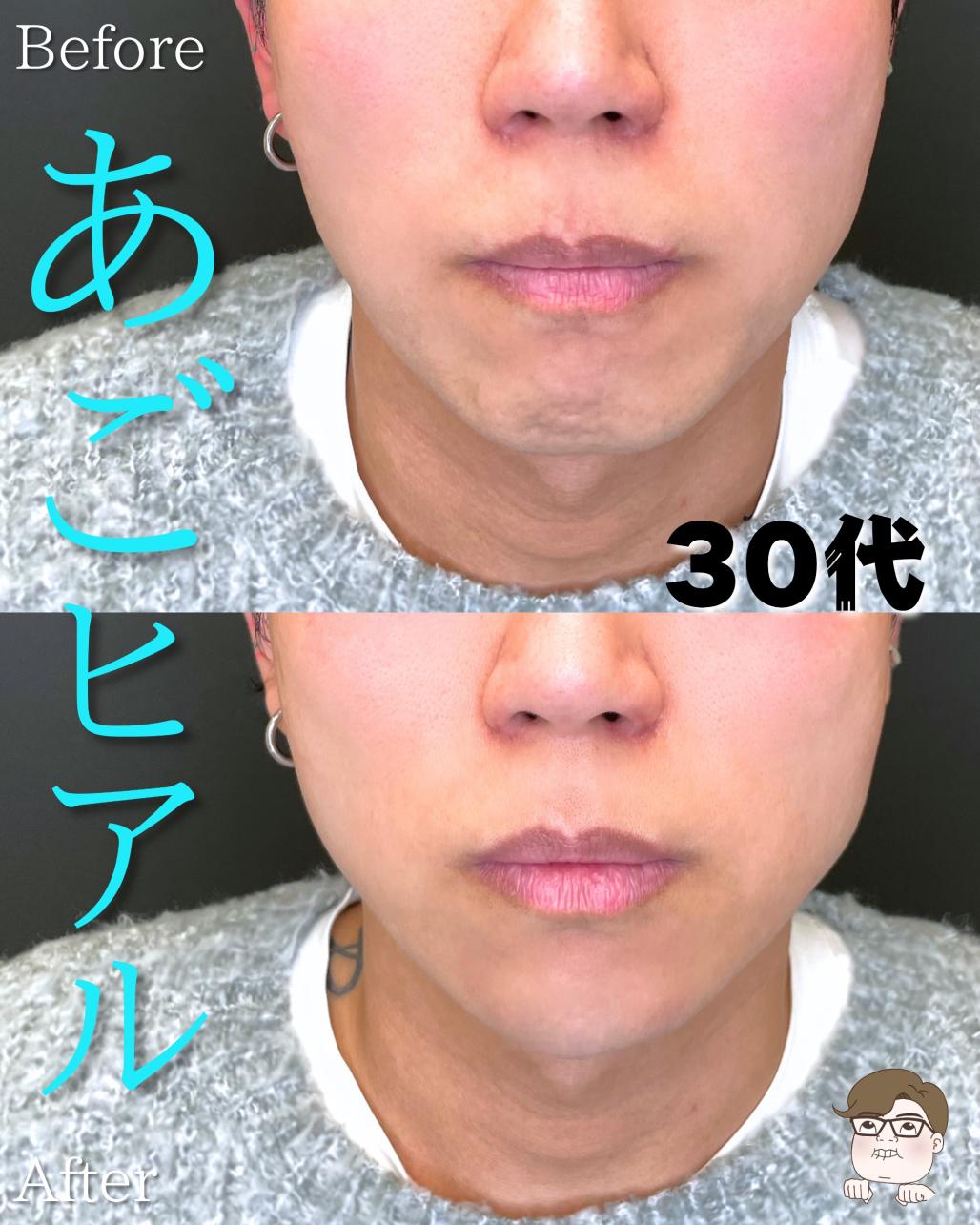 玻尿酸填充