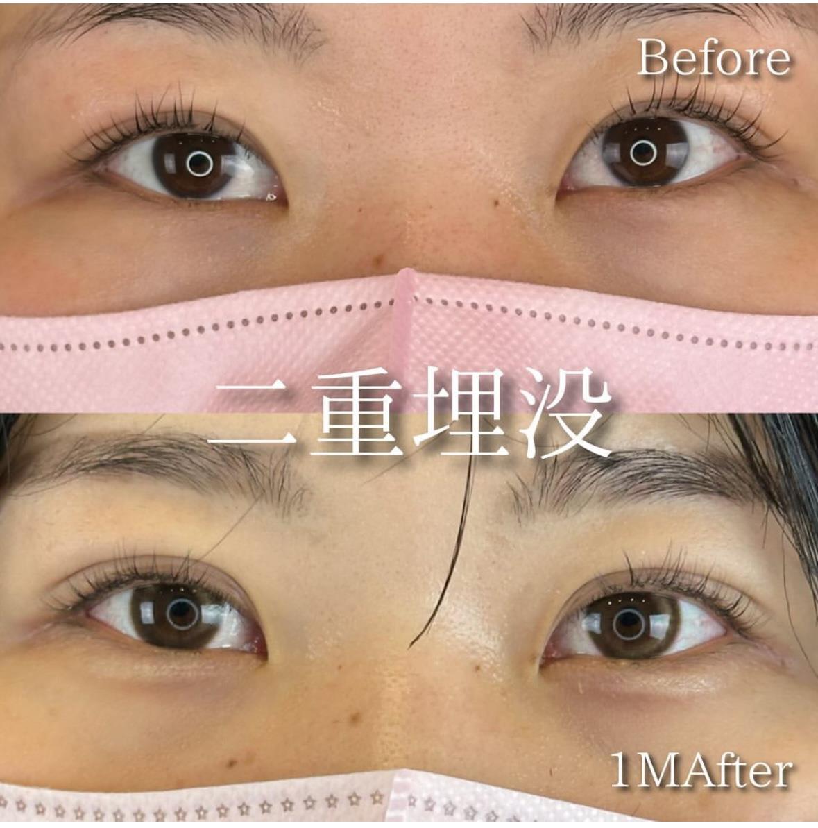 双眼皮手术