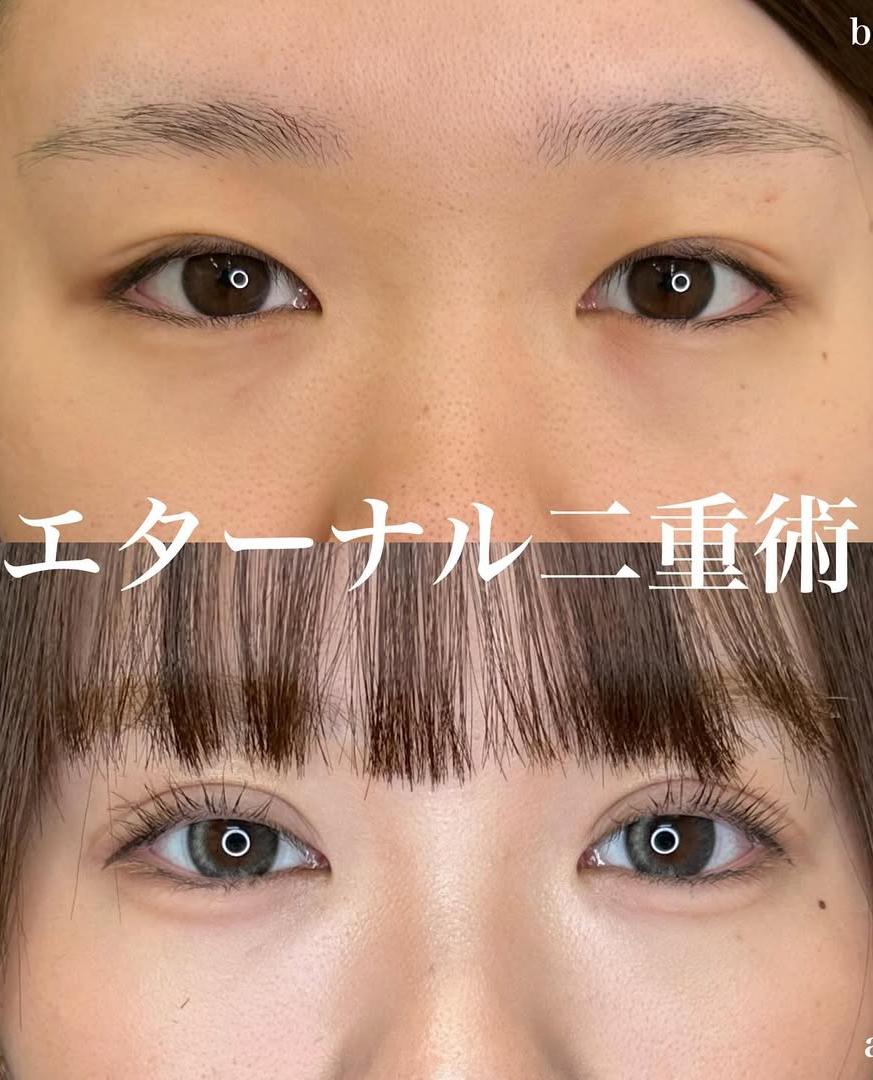 双眼皮手术