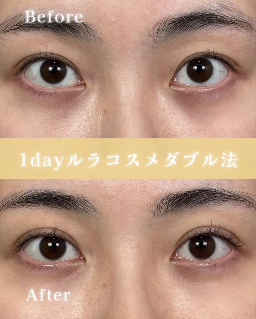 双眼皮手术