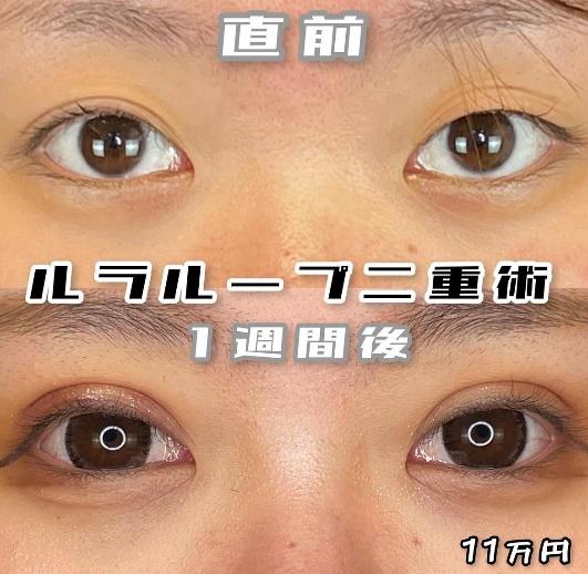 双眼皮手术