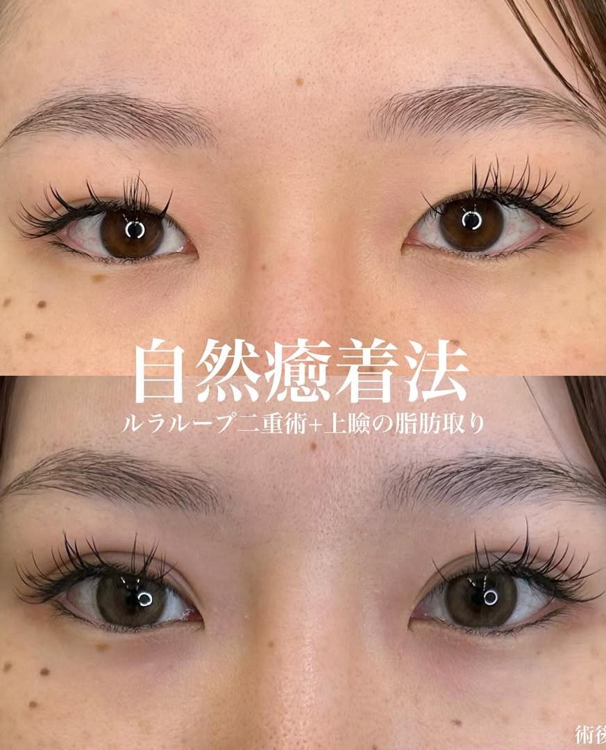 双眼皮手术