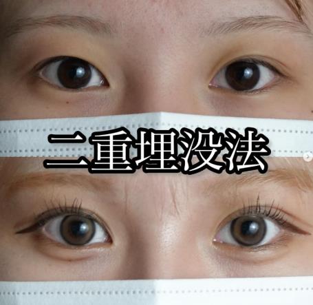 双眼皮手术