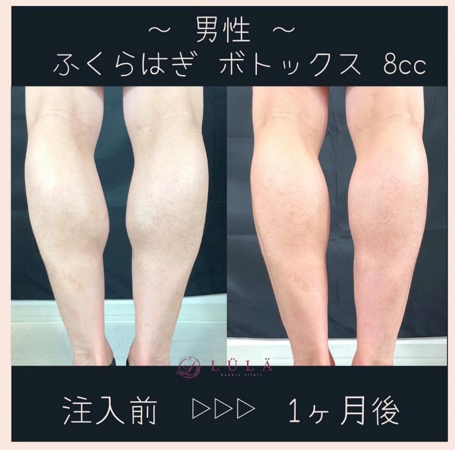 瘦小腿针/瘦大腿针