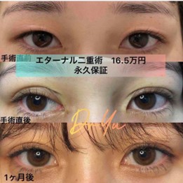 双眼皮手术