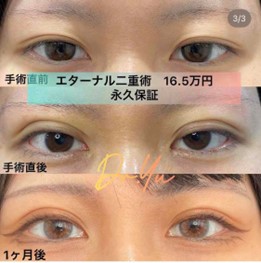 双眼皮手术