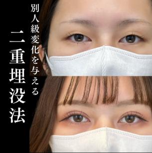 双眼皮手术