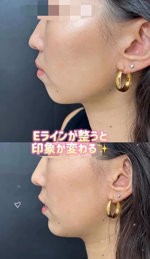 玻尿酸填充