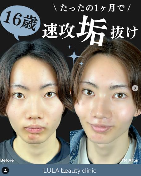 双眼皮手术