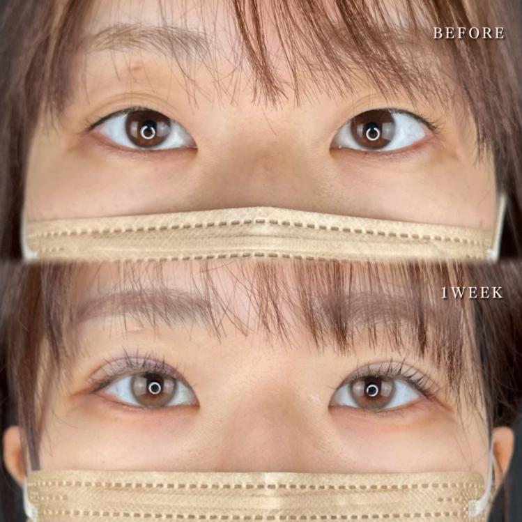 双眼皮手术
