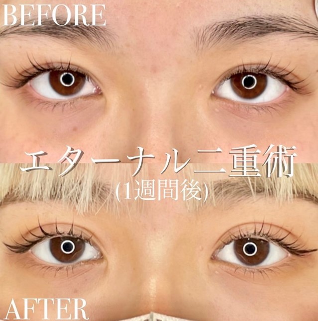 双眼皮手术
