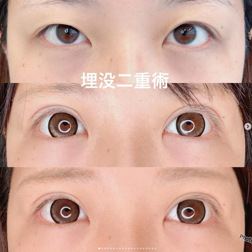 双眼皮手术