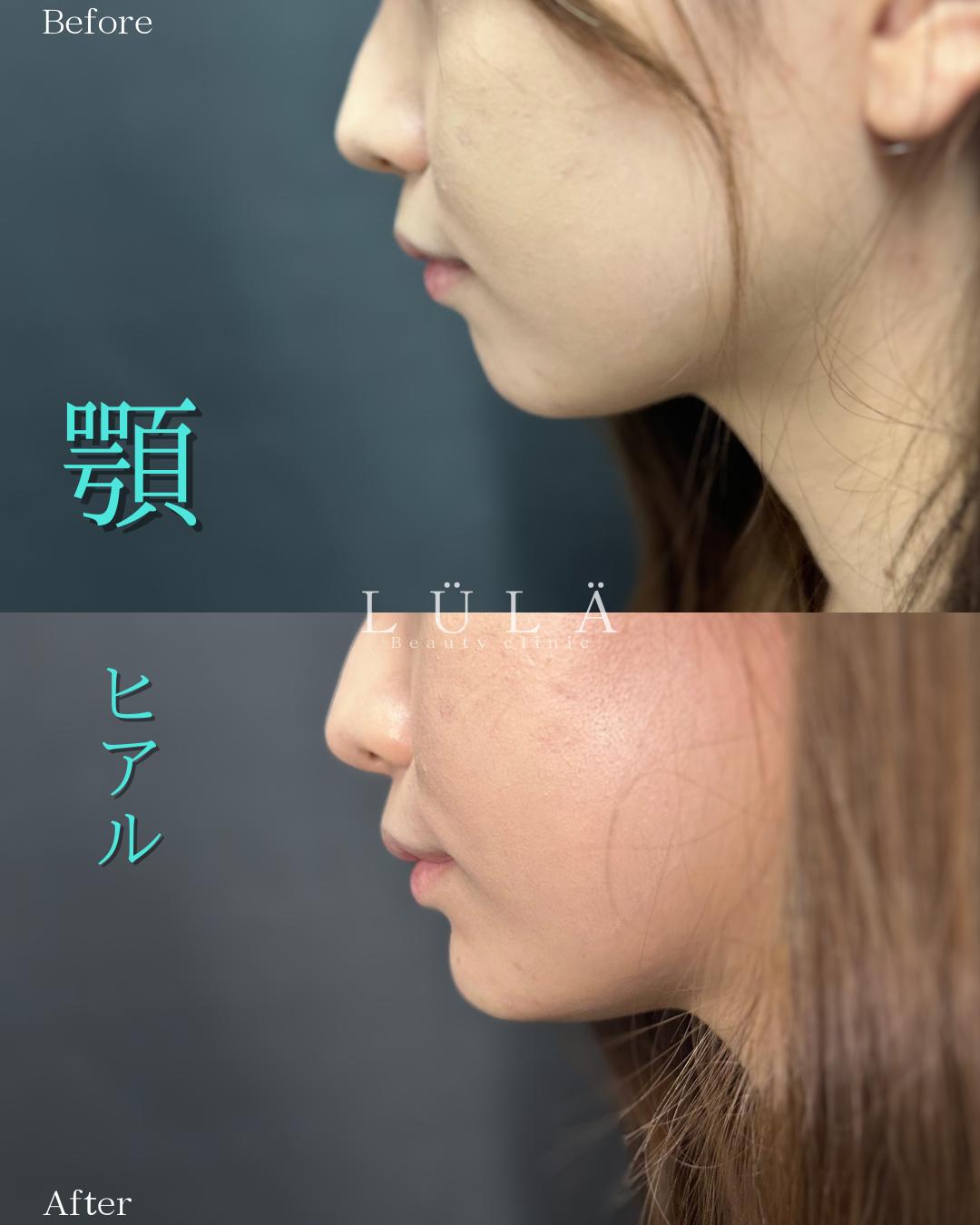 玻尿酸填充