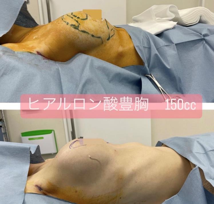 玻尿酸填充 + 玻尿酸丰胸
