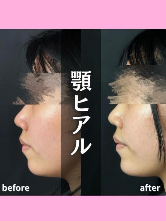 玻尿酸填充