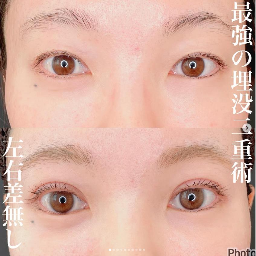 双眼皮手术