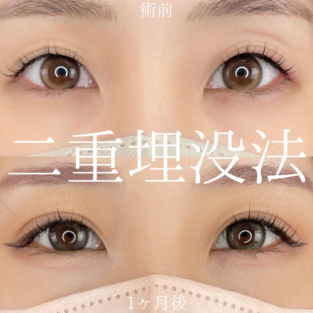 双眼皮手术