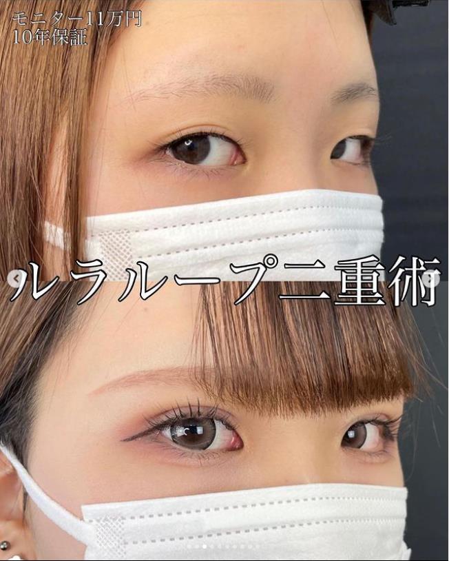双眼皮手术