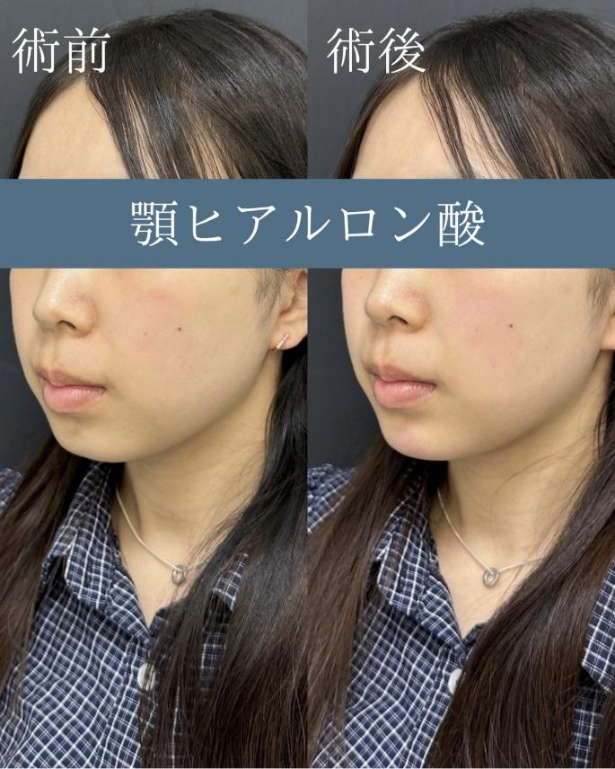 玻尿酸填充