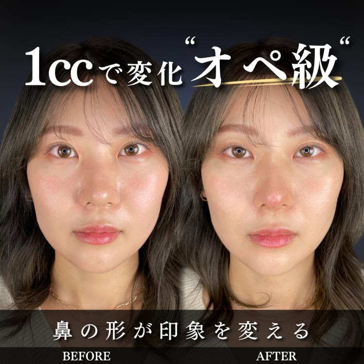 玻尿酸填充