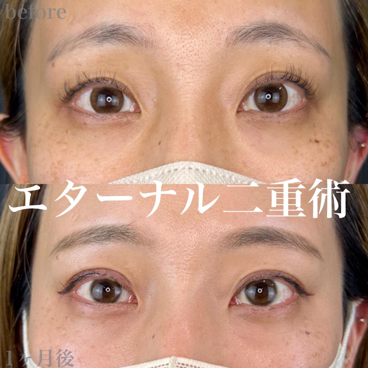 双眼皮手术