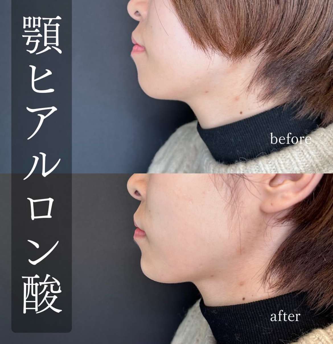 玻尿酸填充