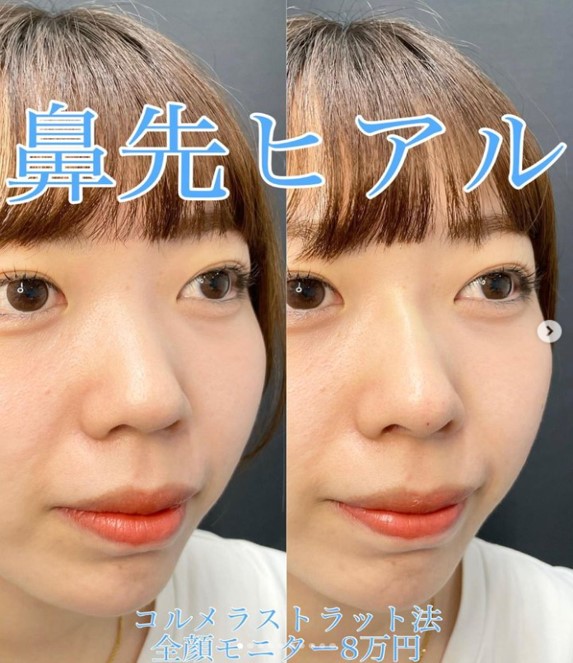 玻尿酸填充