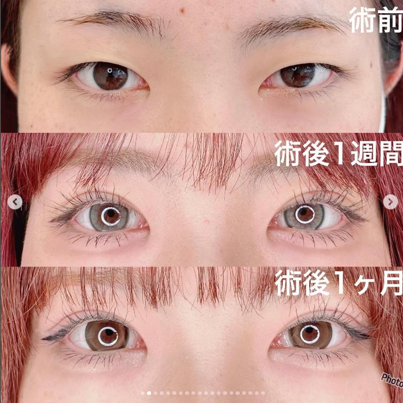 双眼皮手术