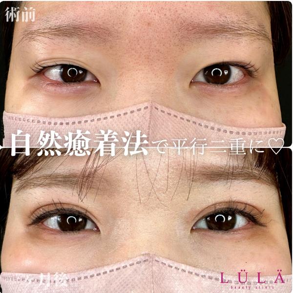 双眼皮手术