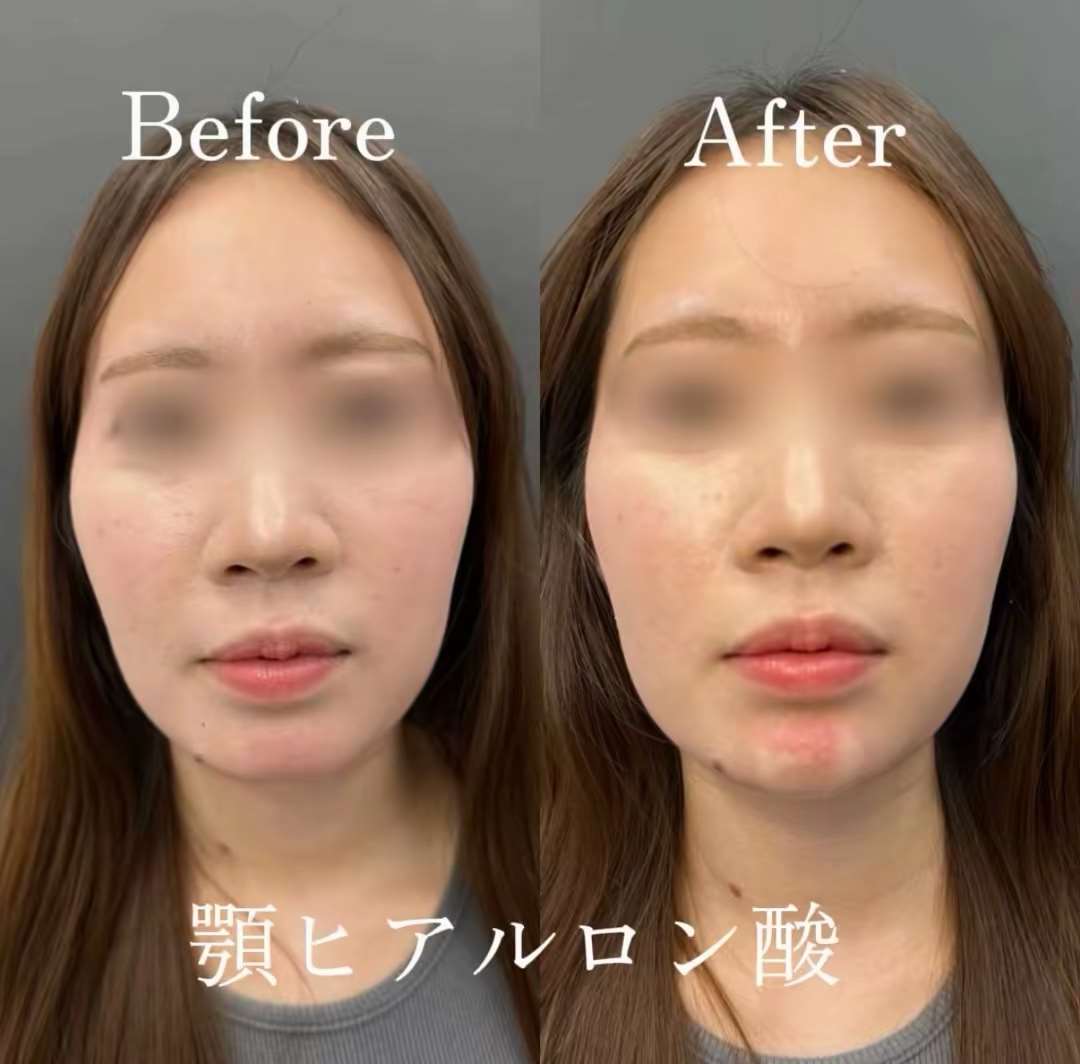 玻尿酸填充