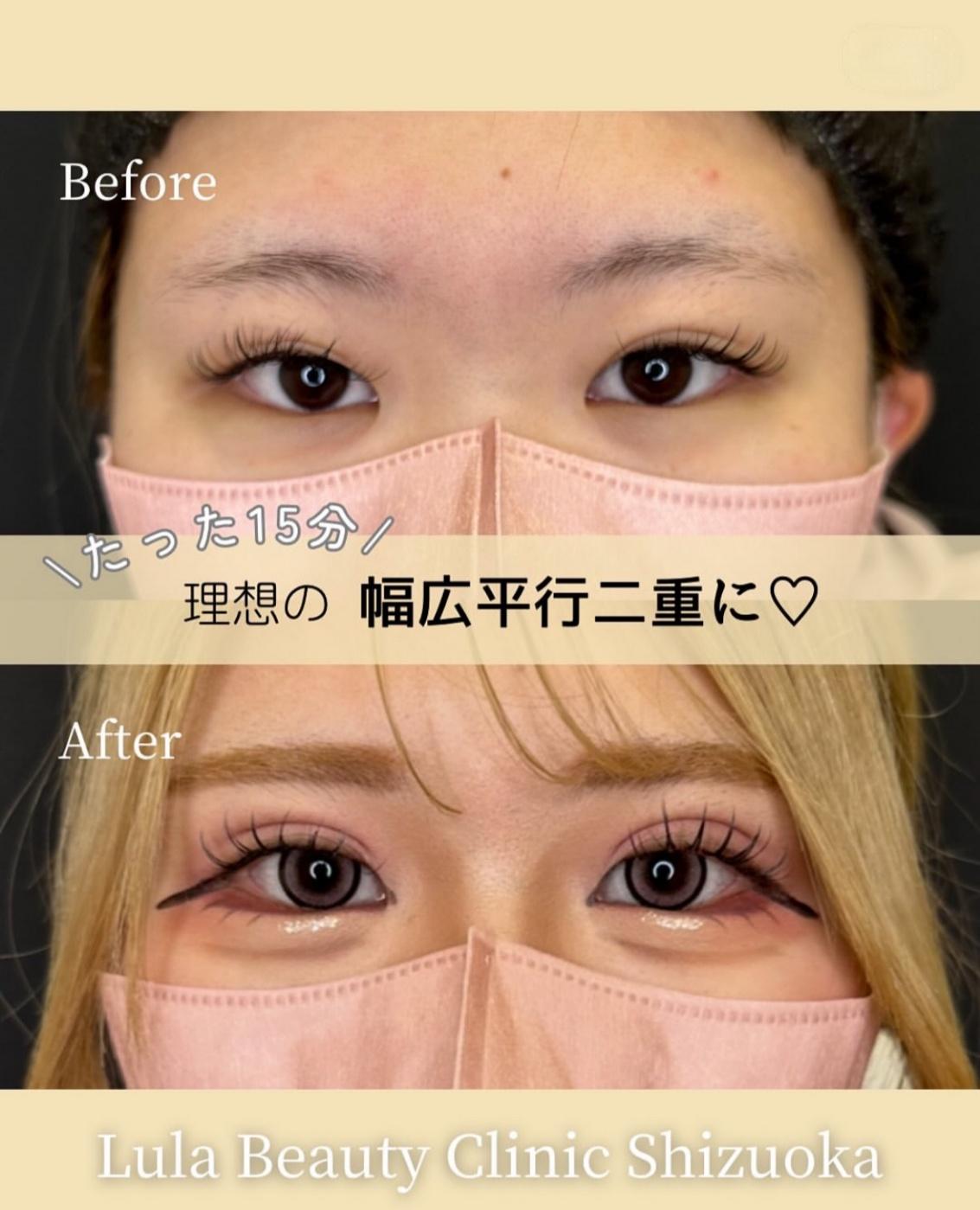 双眼皮手术