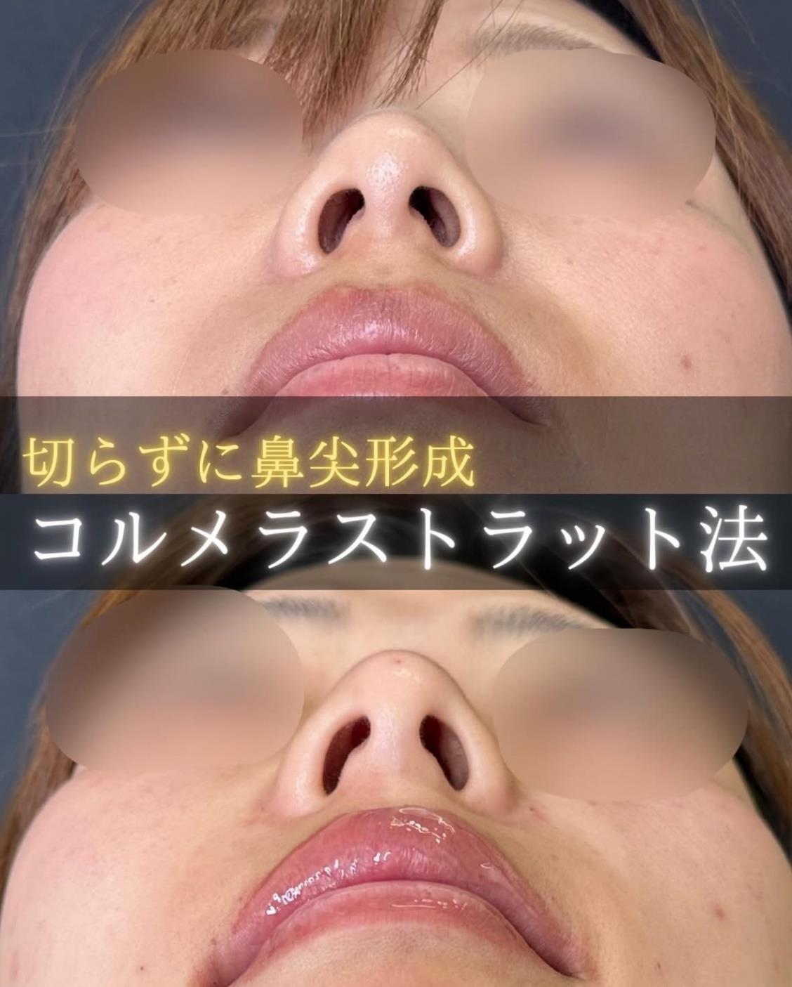 玻尿酸填充