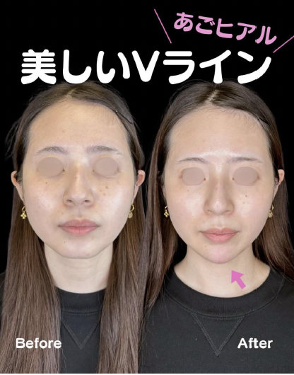 玻尿酸填充