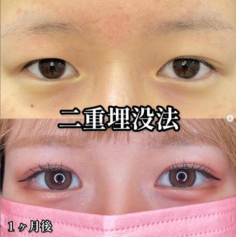 双眼皮手术
