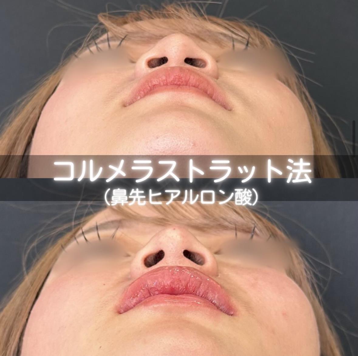 玻尿酸填充