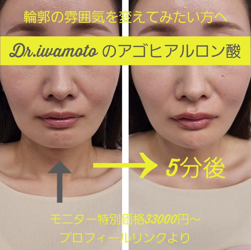 玻尿酸填充