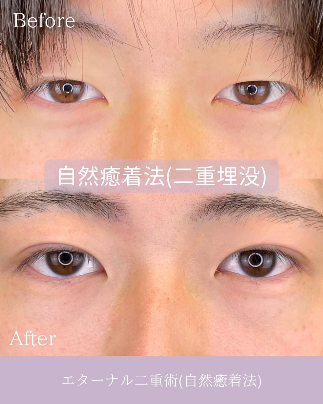 双眼皮手术