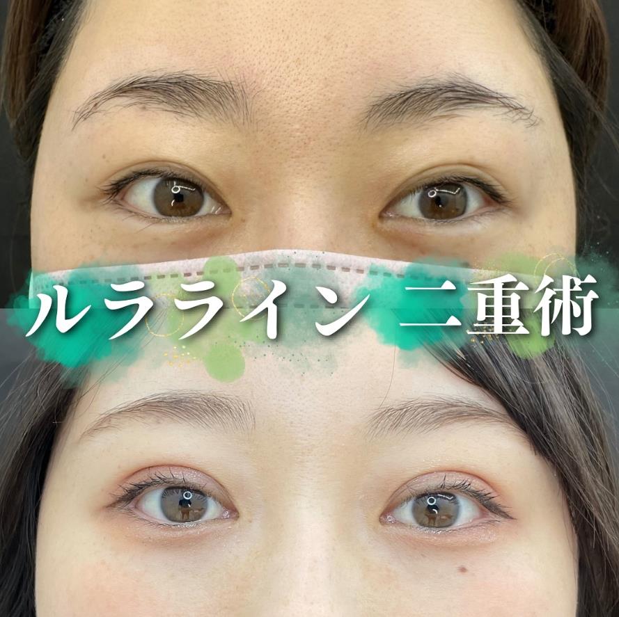 双眼皮手术