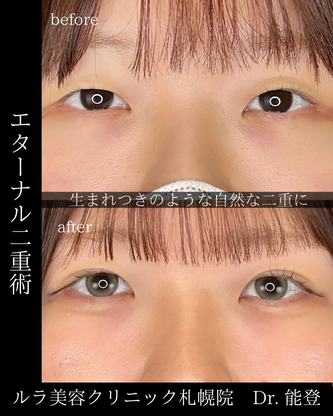 双眼皮手术