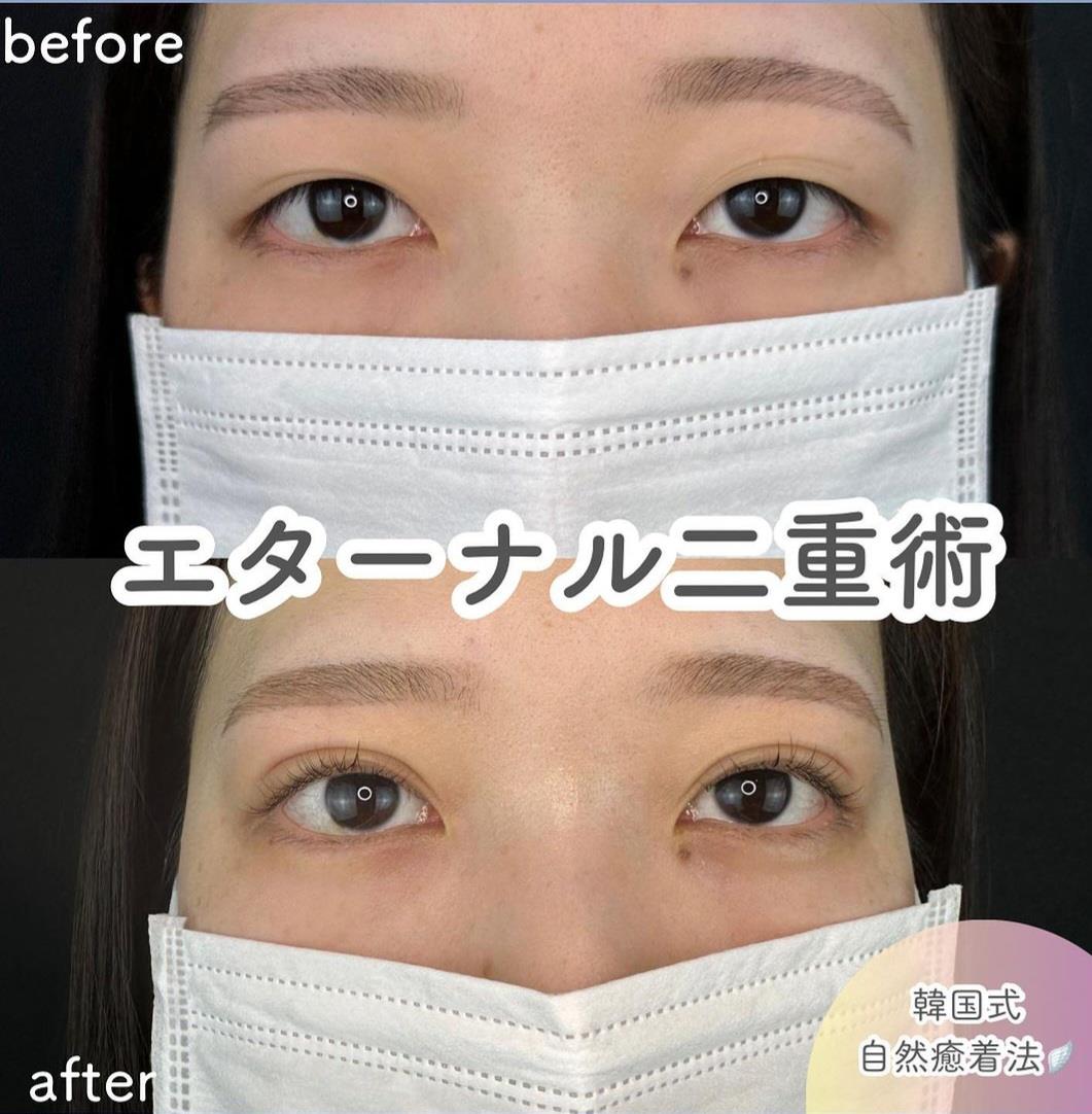 双眼皮手术