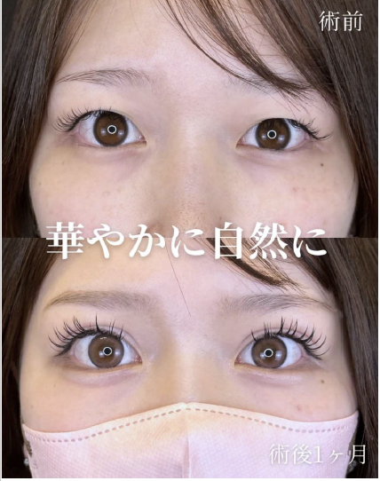 双眼皮手术