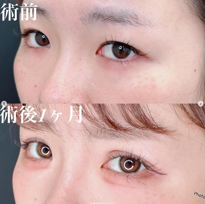 双眼皮手术