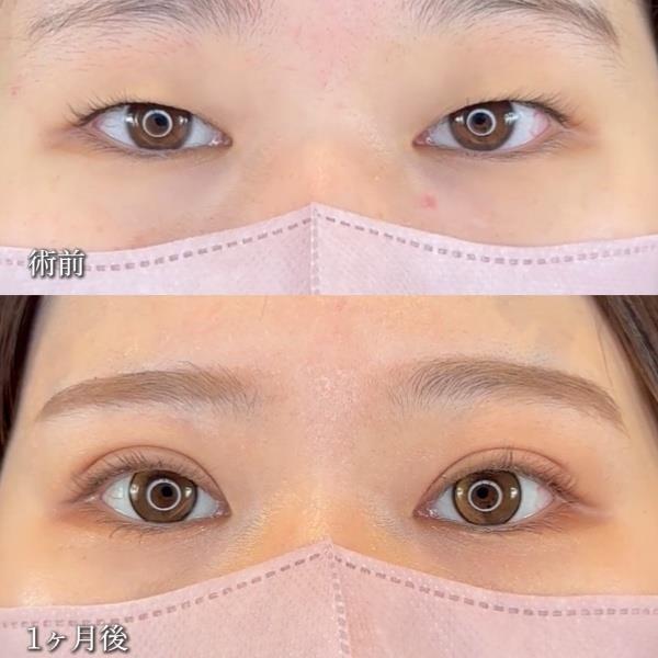 双眼皮手术