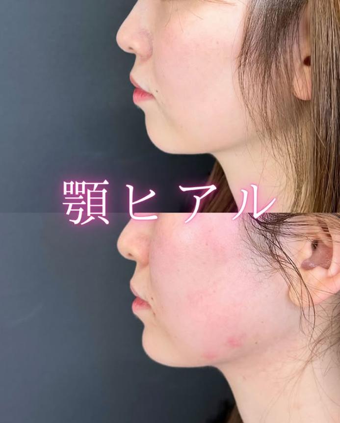 玻尿酸填充