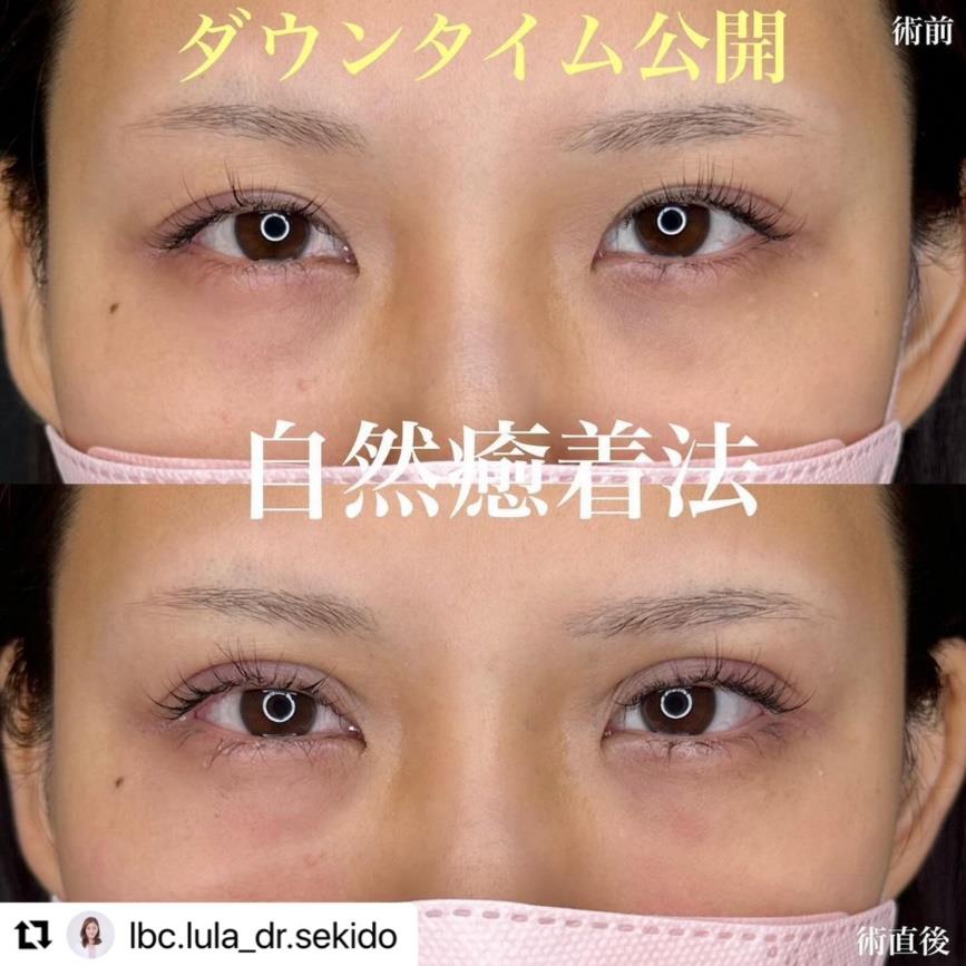 双眼皮手术