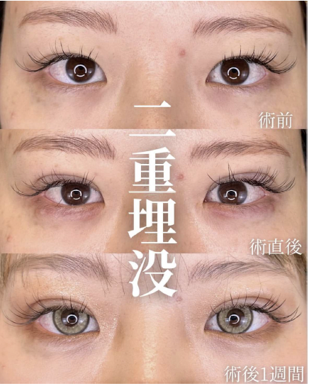 双眼皮手术