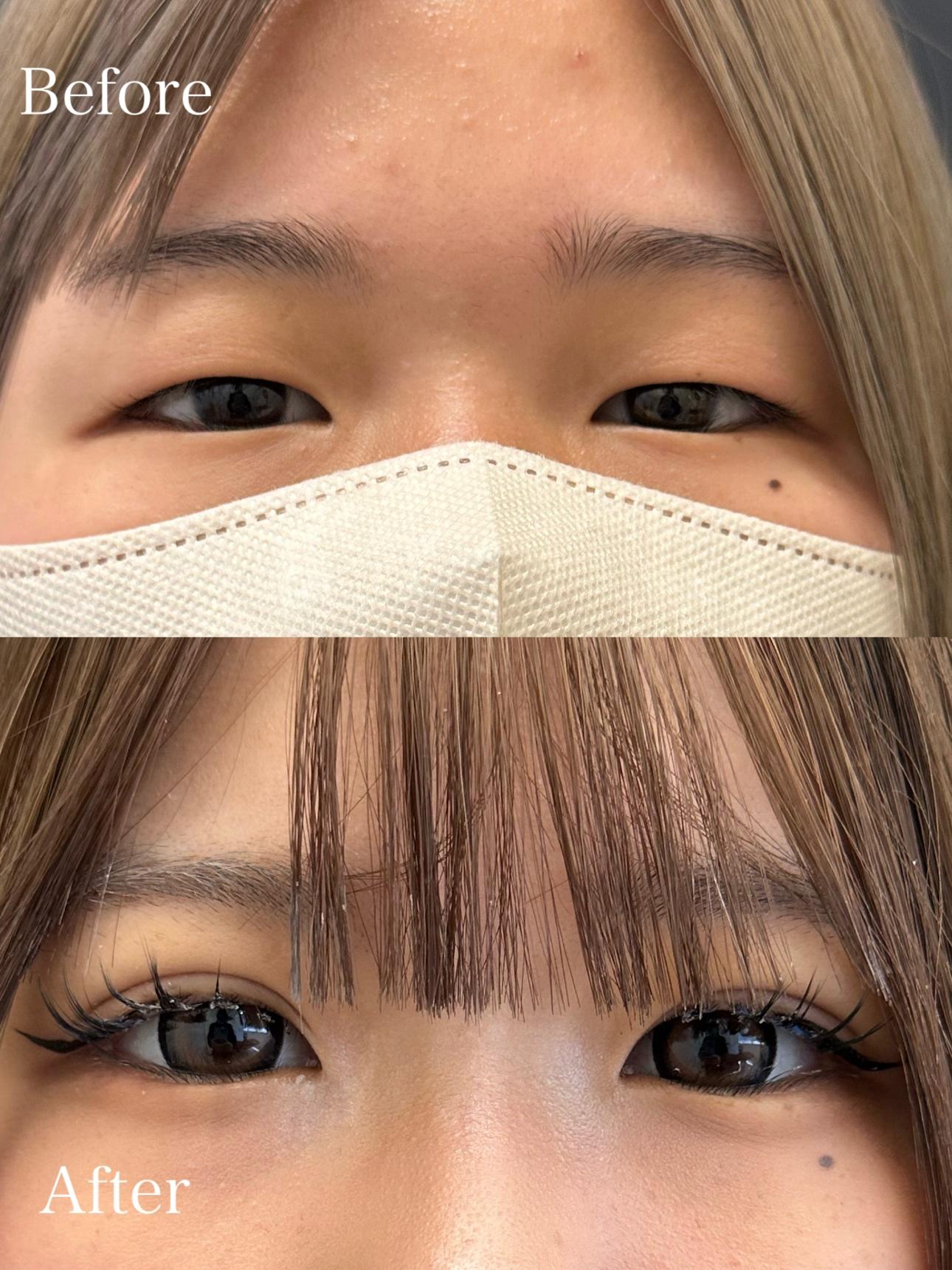 双眼皮手术