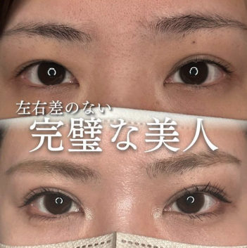 双眼皮手术